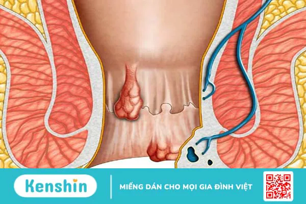 Trĩ hỗn hợp: Nguyên nhân, triệu chứng và cách điều trị 1