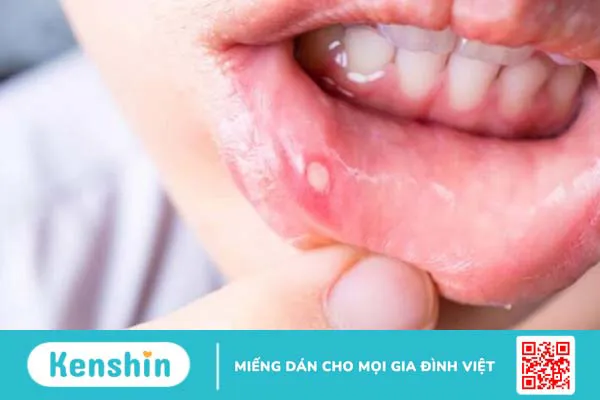 Trị nhiệt miệng bằng xát muối có thật sự hiệu nghiệm? 1