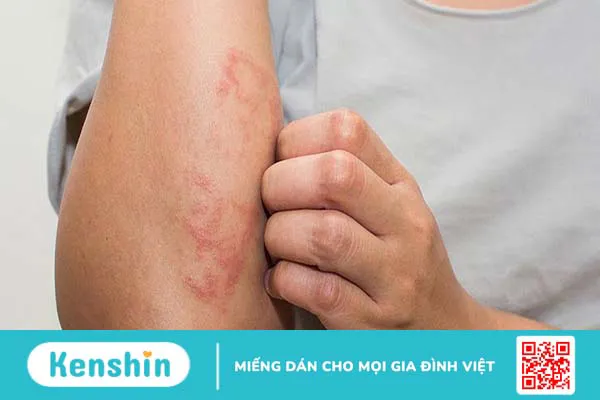 Triệu chứng nổi mụn nước ngứa khắp người là do đâu?