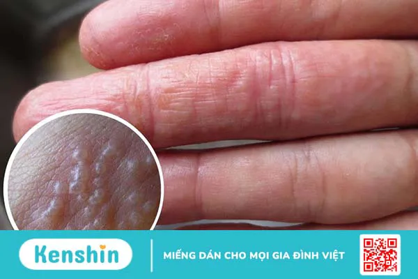 Triệu chứng nổi mụn nước ngứa khắp người là do đâu?