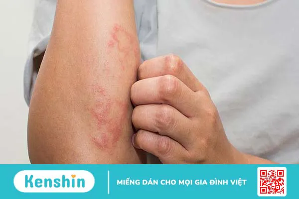 Triệu chứng nổi mụn nước ngứa khắp người là do đâu?