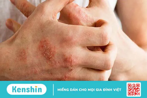 Triệu chứng nổi mụn nước ngứa khắp người là do đâu?