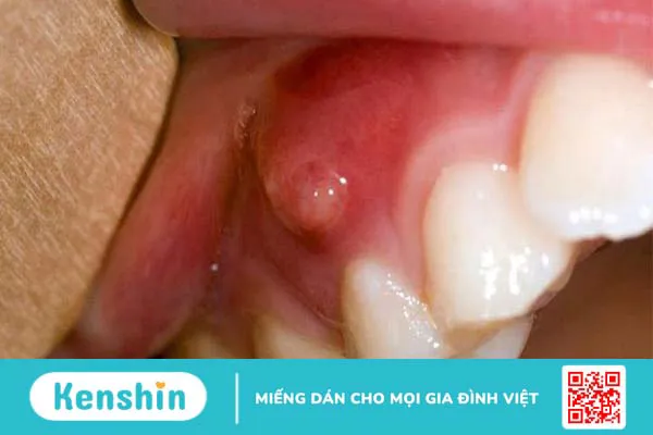 Triệu chứng và cách điều trị áp xe quanh chóp răng