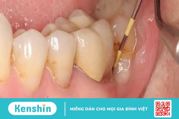 Triệu chứng và cách điều trị áp xe quanh chóp răng 2