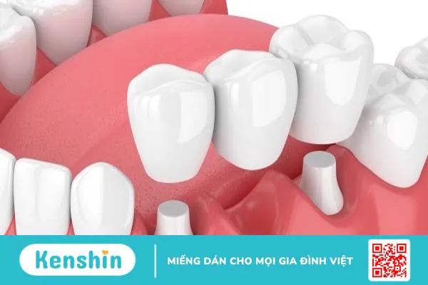 Trồng răng bằng cầu răng và implant nên chọn phương pháp nào?