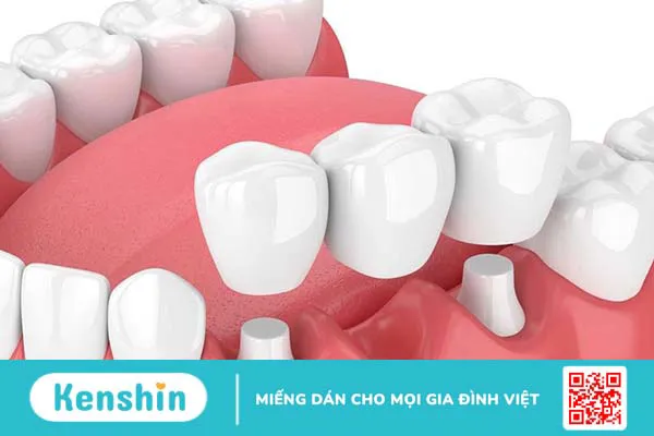 Trồng răng bằng cầu răng và implant nên chọn phương pháp nào?