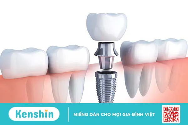 Trồng răng bằng cầu răng và implant nên chọn phương pháp nào?