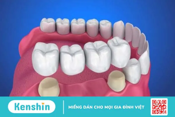 Trồng răng cấm giá bao nhiêu? Nên chọn phương pháp nào?