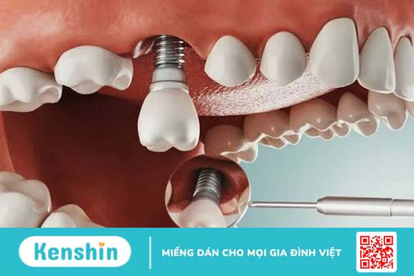 Trồng răng cấm giá bao nhiêu? Nên chọn phương pháp nào? 4