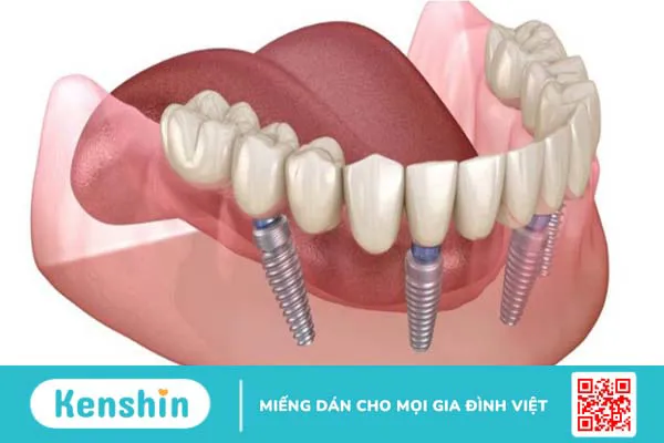 Trồng răng Osstem Implant hiệu quả không?