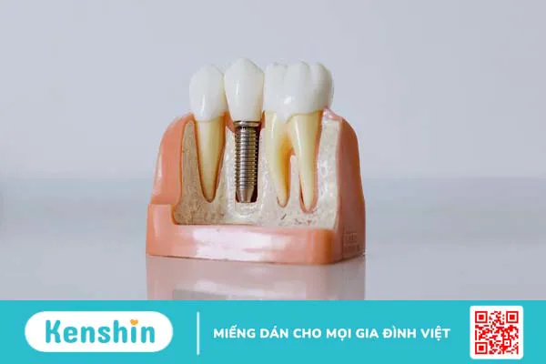 Implant Hiossen 2