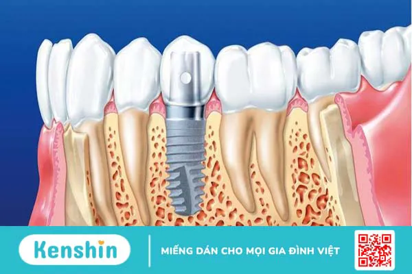 Implant Hiossen 3