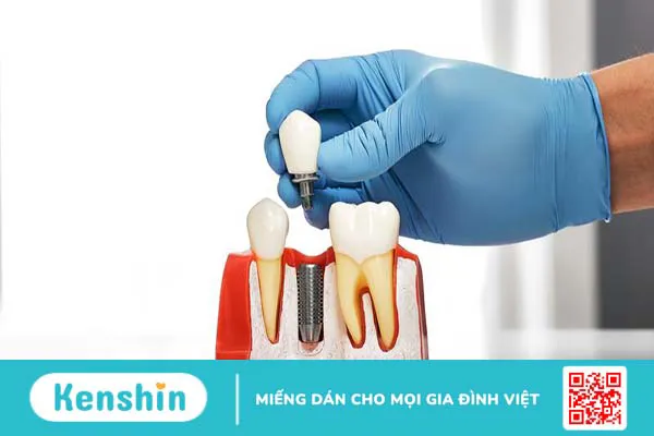 Trụ răng Biotem Implant và những điều cần biết