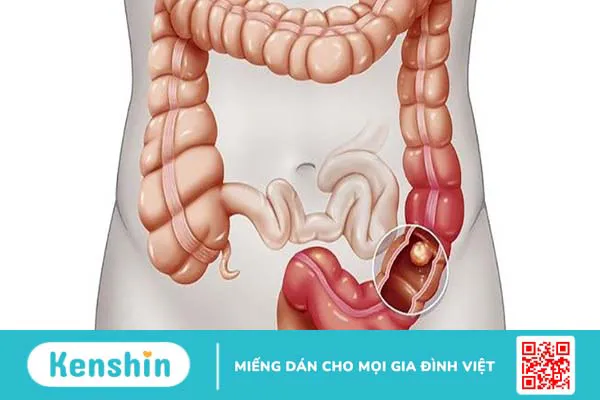 Trực tràng là gì? Cấu tạo, chức năng và các bệnh lý thường gặp