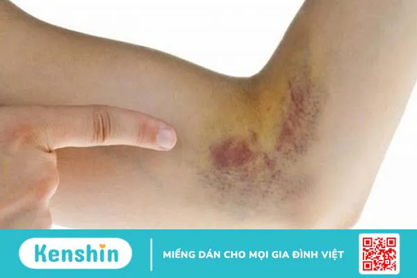 Trường hợp nào cần chụp mạch vành qua da? 01