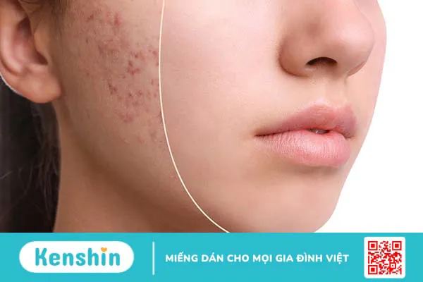 Tự làm nước ép thải độc trị mụn với những nguyên liệu đơn giản