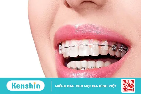 Tư thế ngủ khi niềng răng: Những lợi ích, sai lầm và lưu ý bạn cần biết 3