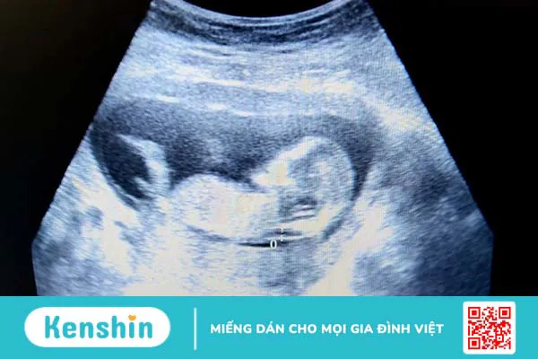 Tư vấn sức khỏe sinh sản: Độ mờ da gáy 1.6 mm có bình thường không?