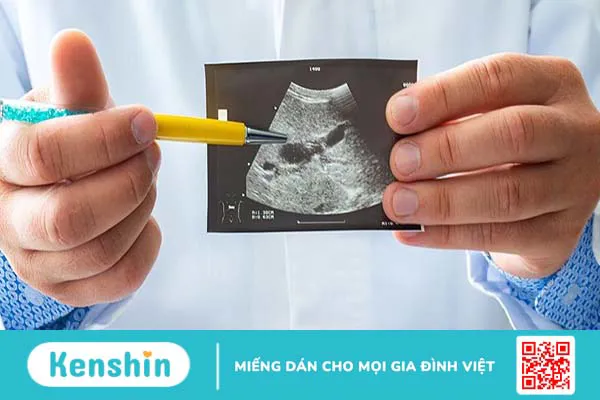 Túi mật sứ: Triệu chứng nhận biết, nguyên nhân, cách chẩn đoán và điều trị