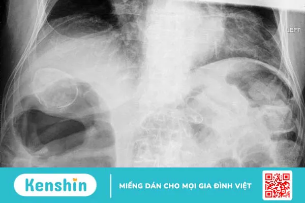 Túi mật sứ: Triệu chứng nhận biết, nguyên nhân, cách chẩn đoán và điều trị 1