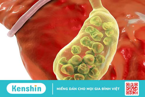 Túi mật sứ: Triệu chứng nhận biết, nguyên nhân, cách chẩn đoán và điều trị 2