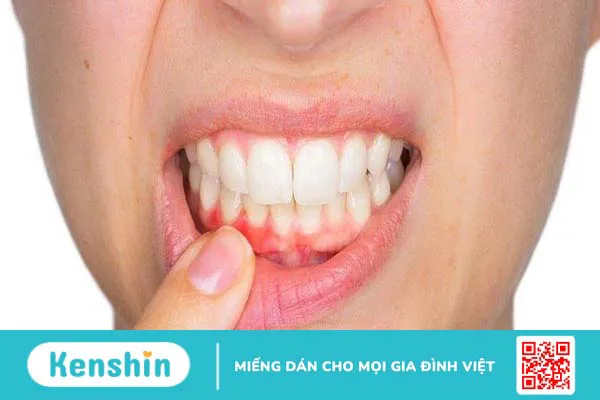 Túi nha chu là gì? Cách điều trị túi nha chu