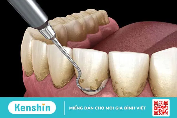 Túi nha chu là gì? Cách điều trị túi nha chu