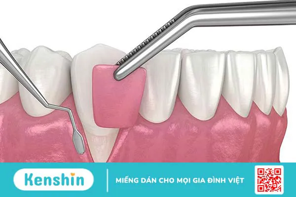 Túi nha chu là gì? Cách điều trị túi nha chu