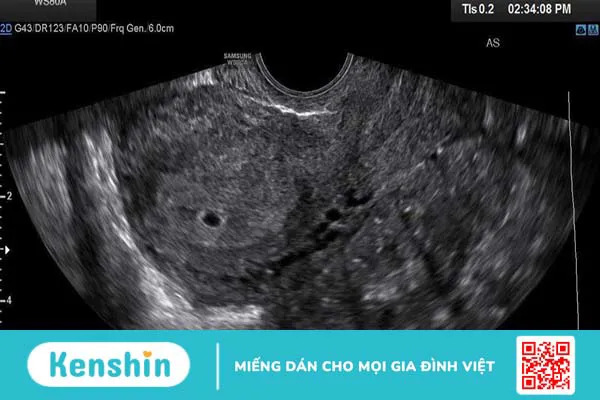 Túi thai 11mm chưa có phôi có sao không? Vì sao siêu âm thấy túi thai nhưng chưa có phôi?