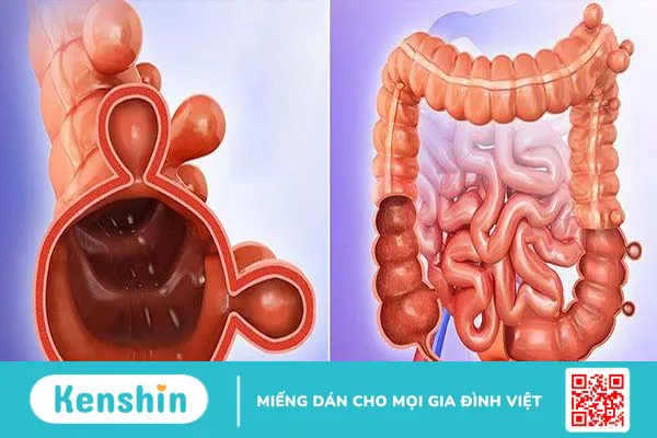 Túi thừa đại tràng: Nguyên nhân, triệu chứng và cách phòng ngừa 3