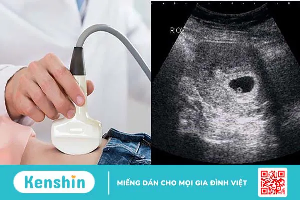 Túi trống âm có phải là túi thai không?