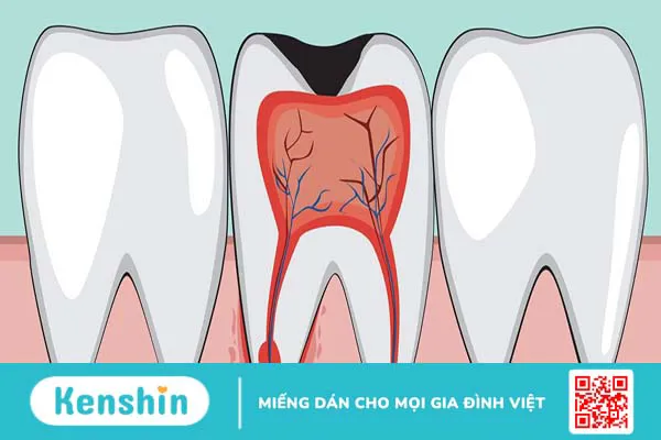 Tủy răng: Cấu tạo, vai trò và bệnh lý thường gặp