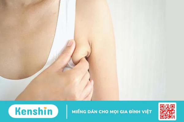 Tuyến vú phụ ở nách là gì? Biểu hiện của tuyến vú phụ 1