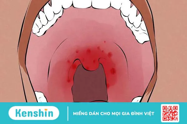 U ác sàn miệng: Dấu hiệu nhận biết và cách phòng ngừa