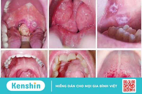 U ác sàn miệng: Dấu hiệu nhận biết và cách phòng ngừa