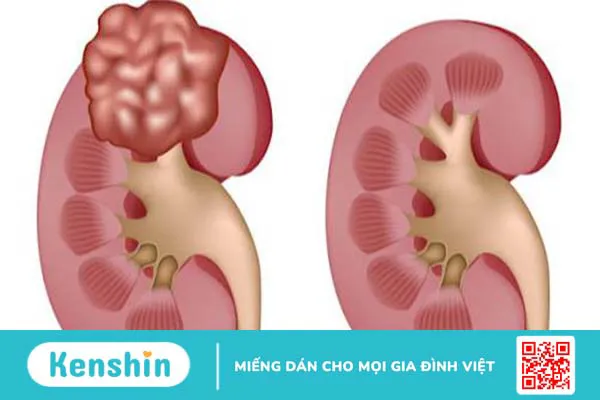 U cơ mỡ mạch thận là gì? Các dấu hiệu nhận biết u cơ mỡ mạch thận