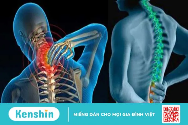 U cột sống là gì? Nguyên nhân, dấu hiệu và cách chẩn đoán