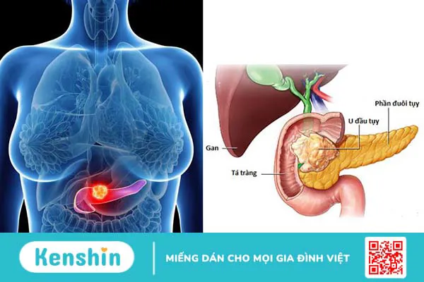 U đầu tụy có nguy hiểm không? U đầu tụy điều trị thế nào?