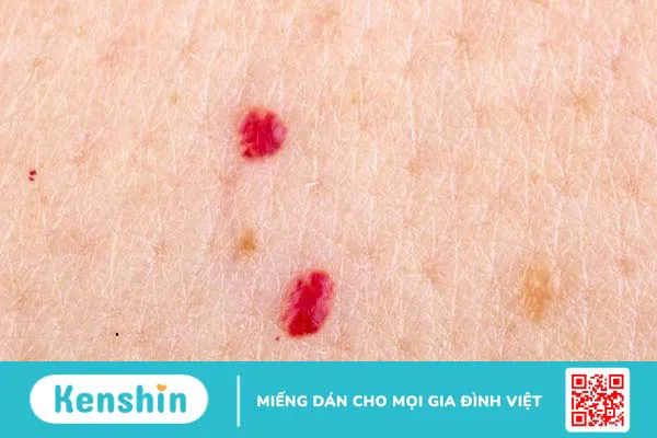 U mạch máu có phải là ung thư không? Nguyên nhân và cách điều trị