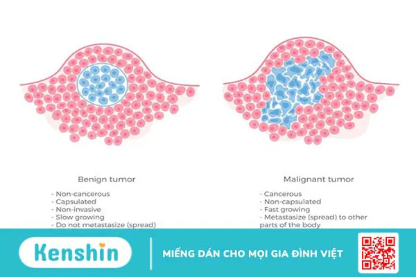 U mạch máu có phải là ung thư không? Nguyên nhân và cách điều trị u mạch máu 3