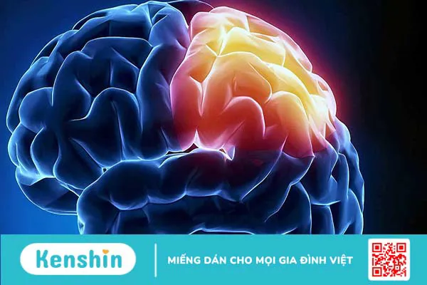 U màng não có nguy hiểm không? Yếu tố nguy cơ và dấu hiệu nhận biết bệnh cần được lưu ý