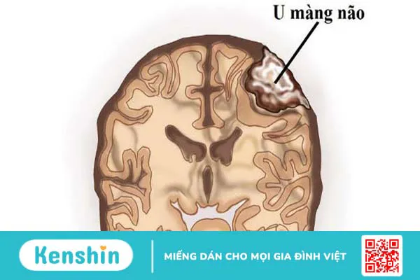 U màng não có nguy hiểm không? Yếu tố nguy cơ và dấu hiệu nhận biết bệnh cần được lưu ý