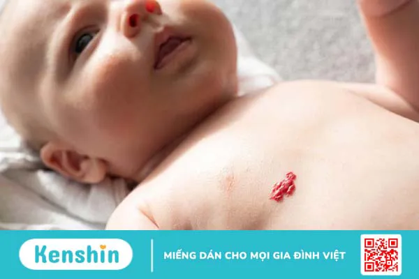 U máu bẩm sinh: Nguyên nhân, triệu chứng và cách điều trị bệnh hiệu quả 2