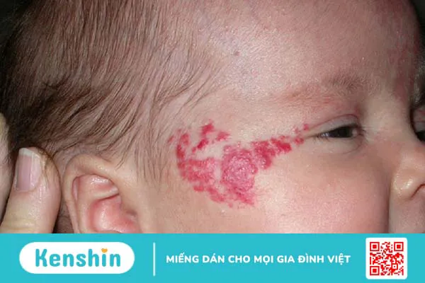 U máu bẩm sinh: Nguyên nhân, triệu chứng và cách điều trị bệnh hiệu quả 3