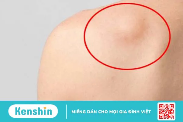 U mỡ ở vai là bệnh gì? U mỡ ở vai có nguy hiểm không?