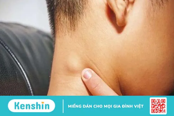 U mỡ sau gáy là gì? Có nguy hiểm không?