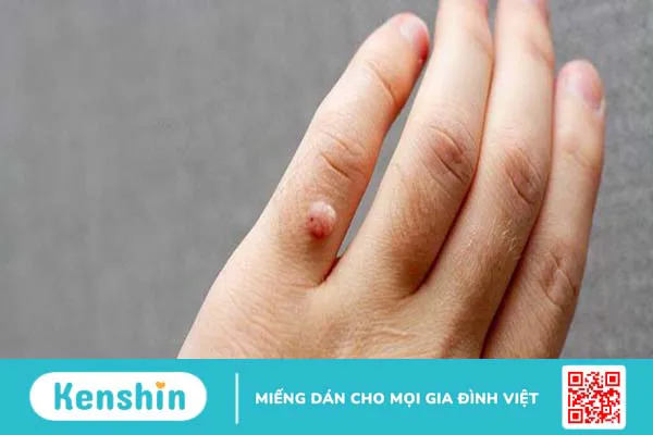 U nhú trên da có nguy hiểm hay không? Phương pháp điều trị u nhú