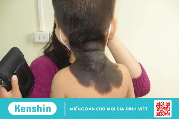 U sắc tố bẩm sinh ở trẻ em: Nguyên nhân, triệu chứng và cách điều trị 2