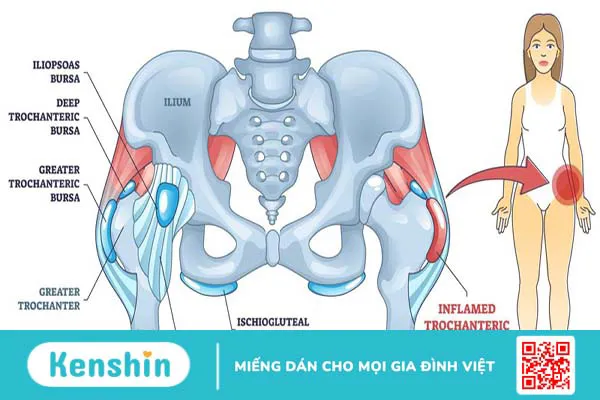 U sụn lấp đầy khớp háng có chữa được không?