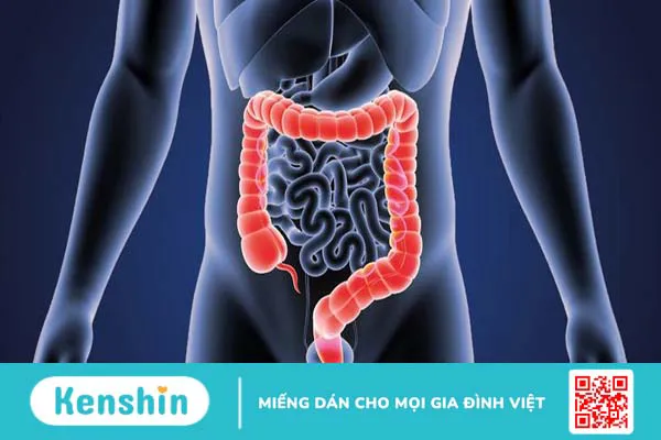 U trực tràng ác tính và những điều cần biết